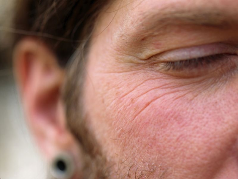 קמטים מתחת לעיניים